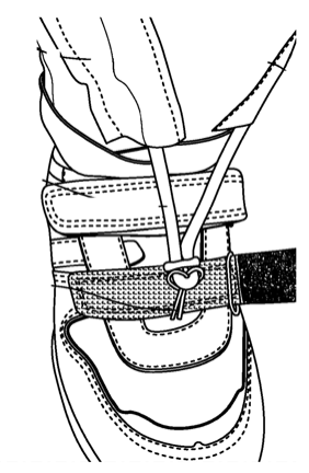 Round OrthoPed clasp being twisted to adjust tension